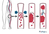 thromvex 