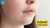 هيرسوستوب 11.5% كريم موضعي 60جم